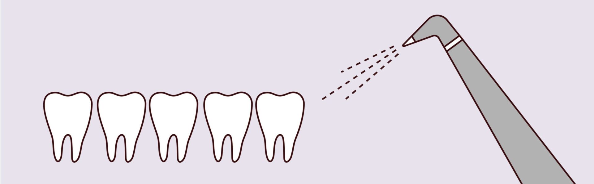 Air Abrasion Dentistry - Pure Gold Professionals in Dentistry - Redlands Dentist - Pure Gold Professionals in Dentistry - Redlands Dentist -